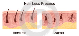 Alopecia. Hair loss, balding process. Cross-section anatomical structure