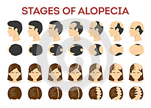 Alopecia stages set. Hair loss, balding process. Female