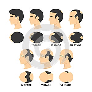 Alopecia stages set. Hair loss, balding process. Male