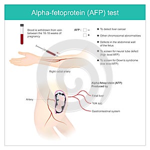 Alpha-fetoprotein AFP test. Use Analysis by AFP level. to dete