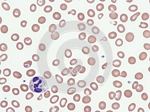 Alpha-thalassemia in peripheral blood.