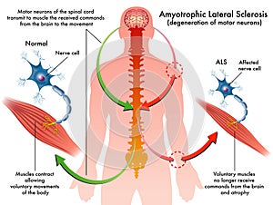 ALS (amyotrophic lateral sclerosis)