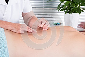 Alternative medicine Close-up male back with steel needles during procedure of acupuncture