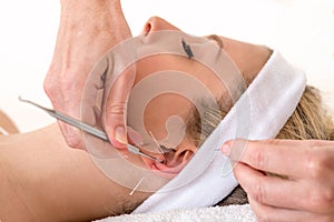 Alternative practitioner treating woman with acupuncture.