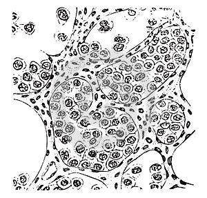 Alveolar sarcoma, vintage engraving