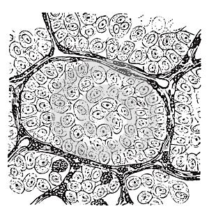 Alveolar sarcoma, vintage engraving