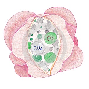 Alveoli group showing chronic obstructive pulmonary disease in alveoli.