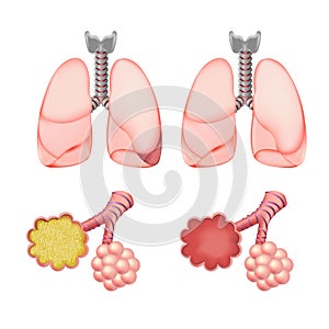 Alveoli In Lungs Set