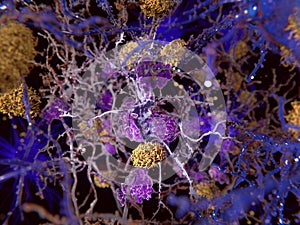 Alzheimer disease, neuron being phagocyted by microglia cells