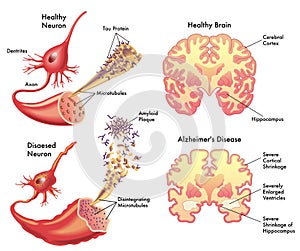 Alzheimer's disease