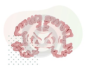 Alzheimer`s Disease - Brain Transverse Section - Illustration