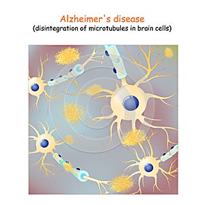 Alzheimer`s disease. dementia. Vector Background with neurons and amyloid plaques photo