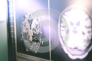 Alzheimer`s disease on film MRI hippocampus atophy