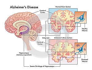 Alzheimer`s disease photo