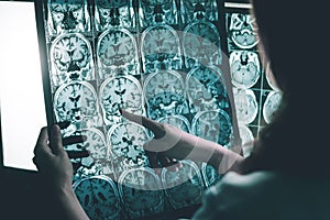 Alzheimer`s disease on MRI