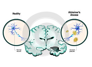 Alzheimer`s disease. Neurons and brain