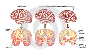 Alzheimer's disease progression