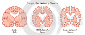 Alzheimer's disease stages. Human brain cross section, affected with progressive