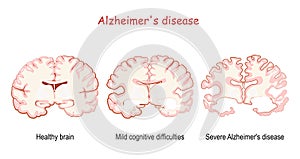 Alzheimer`s, is a neurodegenerative disease. dementia