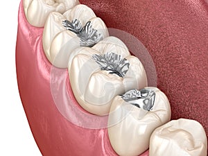 Amalgam restoration. Medically accurate 3D animation of dental concept