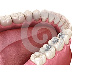 Amalgam restoration. Medically accurate 3D animation of dental concept