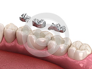 Amalgam restoration. Medically accurate 3D animation of dental concept