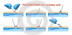 Ambulatory Phlebectomy Treatment for varicose vein.