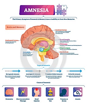 Amnesia vector illustration. Labeled brain memory loss disease types scheme photo