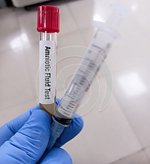 Amniocentesis (amniotic fluid test). a test done during pregnancy (15 to 20 weeks).