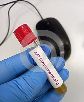 Amniocentesis (amniotic fluid test). a test done during pregnancy (15 to 20 weeks).