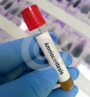 Amniocentesis (amniotic fluid test). a test done during pregnancy.