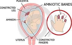 Amniotic bands. fetus is entangled in fibrous string-like amniotic bands in the womb