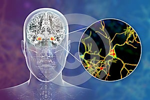 Amygdala in the brain, and closeup view of amygdala neurons, 3D illustration