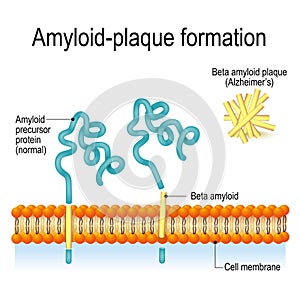 Amyloid-plaque formation. Alzheimer`s disease photo