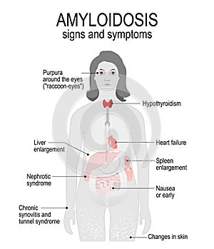Amyloidosis. Signs and symptoms. photo