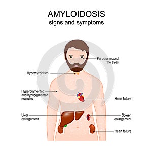 Symptoms of Amyloidosis photo