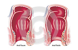 Anal fissure and fistula photo