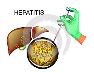 Analysis for hepatitis C and liver disease photo