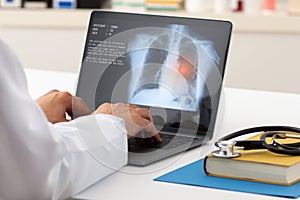 Analyzing an x-ray of the lung