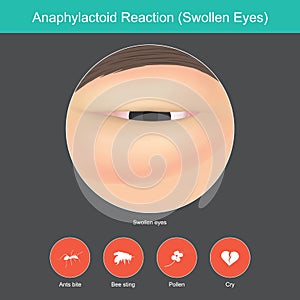 Anaphylactoid Reaction. Illustration show close up. photo