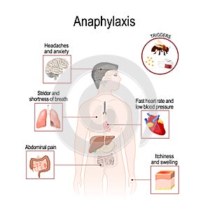 Anaphylaxis is a serious allergic reaction that may cause death