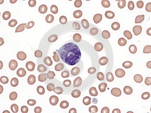 Anaplastic large-cell lymphoma. Peripheral blood.