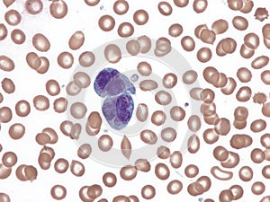 Anaplastic large-cell lymphoma. Peripheral blood.