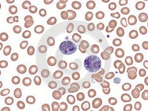 Anaplastic large-cell lymphoma. Peripheral blood.