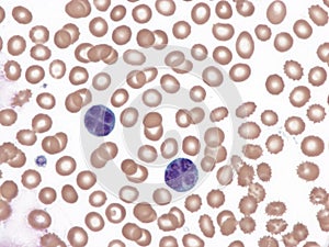 Anaplastic large-cell lymphoma. Peripheral blood. photo