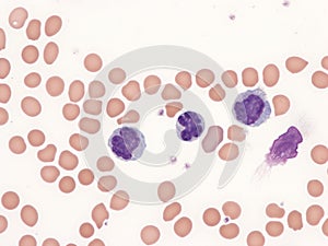 Anaplastic large cell lymphoma photo