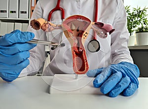 Anatomical model of uterus with pathologies closeup