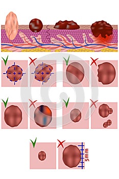 The anatomical structure of a mole and melanoma.