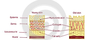 The anatomical structure of the skin. Elastin, hyaluronic acid, collagen. Skin aging, wrinkles before and after photo