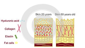 The anatomical structure   the skin. Elastin, hyaluronic acid, collagen. Skin aging, wrinkles before and after photo
